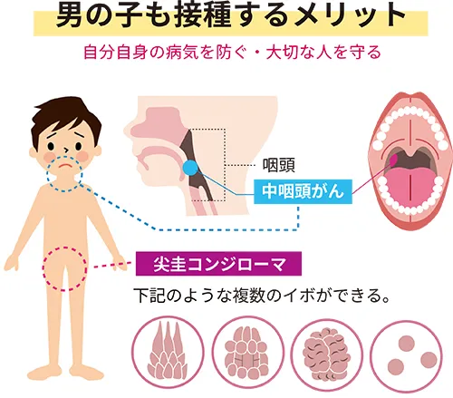 男の子も接種するメリット(自分自身の病気を防ぐ・大切な人を守る)